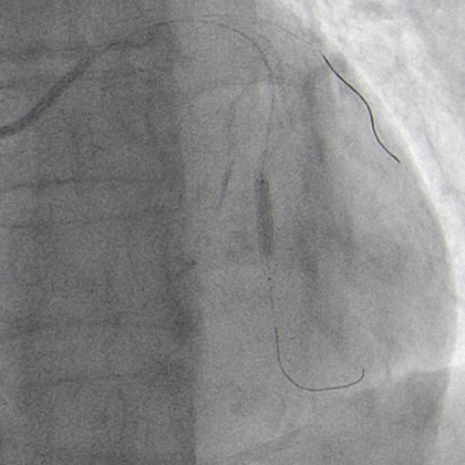 Covered stent implantation