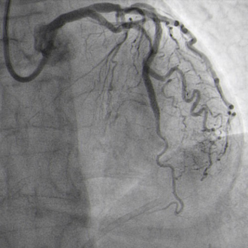 Final result with TIMI III flow