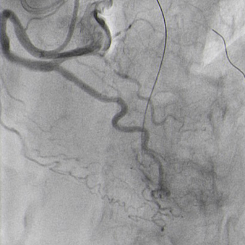 Double radial access with guiding catheter JR 4.0 6F and sheatless PB 3.5 7,5F