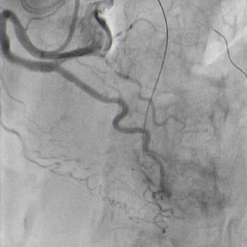 Double radial access with guiding catheter JR 4.0 6F and sheatless PB 3.5 7,5F