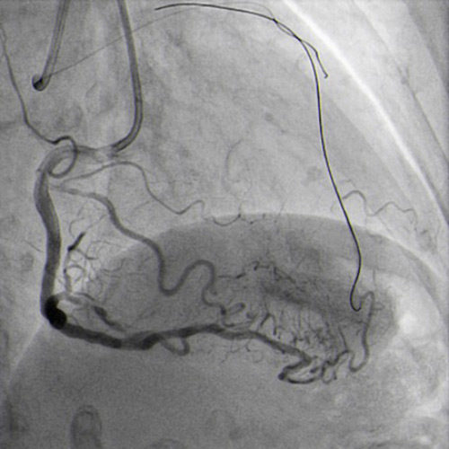 Floppy wire in diagonal branch to improve support.