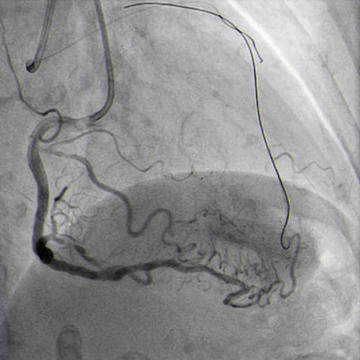 Floppy wire in diagonal branch to improve support.