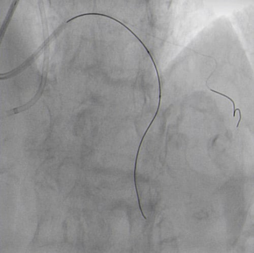 2.0 x 20 mm NC balloon predilatation