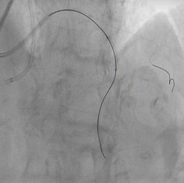 2.0 x 20 mm NC balloon predilatation