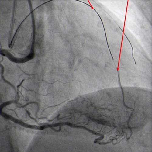 Wire position checked via controllable injection