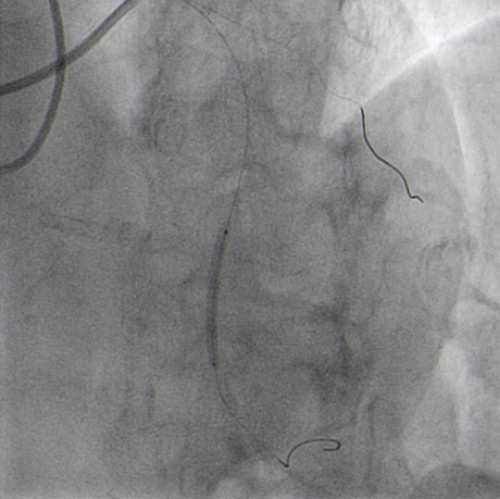 NC 2.5 x 30 mm balloon predilatation and  2 DES implantation in overlapping