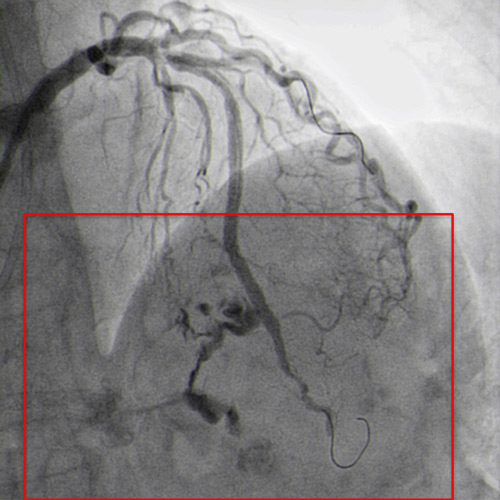 Type III coronary perforation and sudden cardiac tamponade occurred.