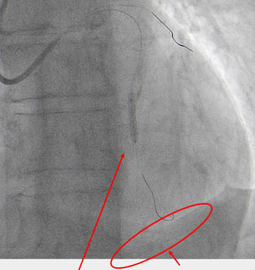 Quick pericardiocentesis with 6F femoral sheat