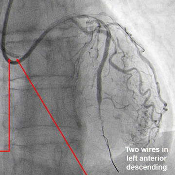 Second wire removed and PCI completed with another DES implantation in proximal LAD