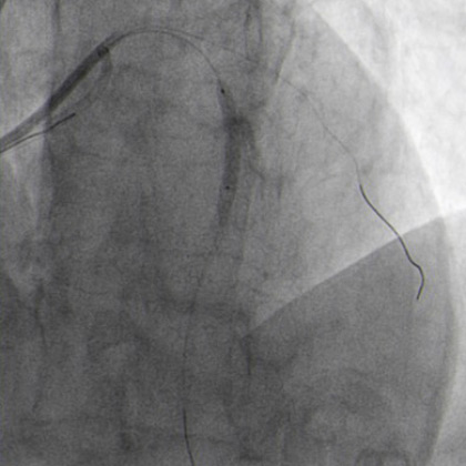 The second wire was removed and PCI completed with another DES implantation in proximal LAD.