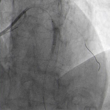The second wire was removed and PCI completed with another DES implantation in proximal LAD.