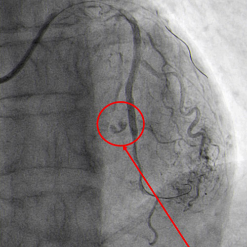 Angiographic control showed mild perforation recurrence