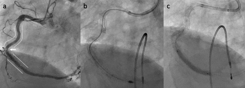 A good start with initial procedure!