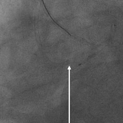 JL catheter use 