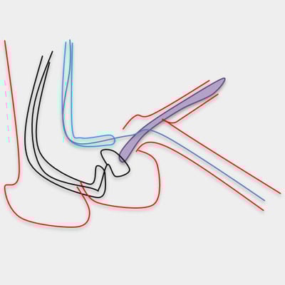 Making co-axial between snare and balloon