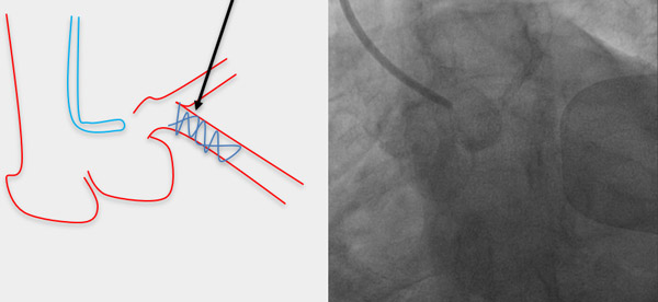 Longitudinal stent compression from guiding catheter