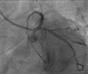 Final angiogram showed good result