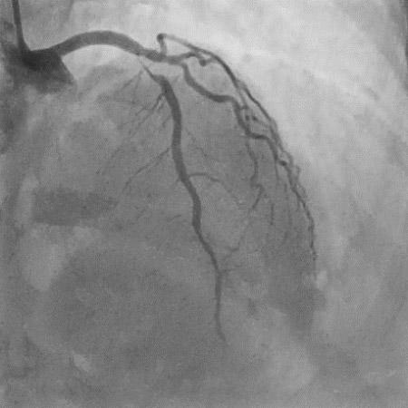 CAG-LAD Proximal 99% lesion