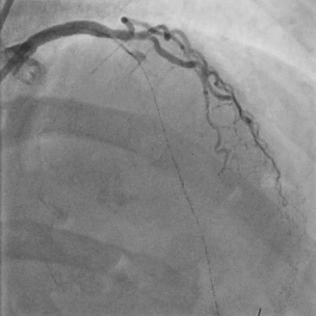 LAD Lesion crossed with 0.014 X 190cms" Sion Blue wire. D1 crossed with 0.014" Versaturn wire