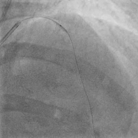 Pre-dilatation done with 1.5 X 10 mm Tazuna balloon