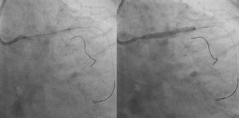 RAMUS wire / LMCA to LAD stenting done with 3.0 x 30mm Orsiro stent