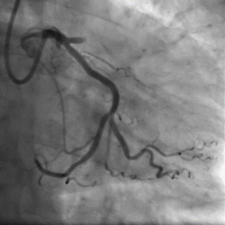 Occlusion of the proximal LAD