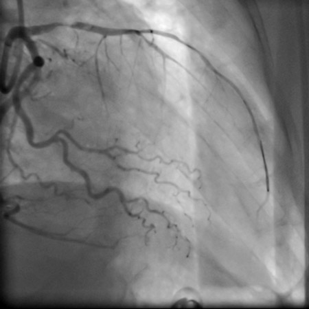 Balloon pre-dilatation, very small LAD