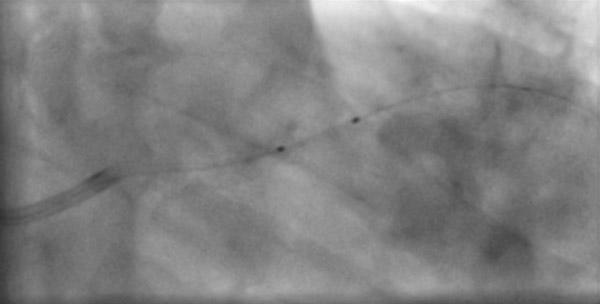 Rupture of the catheter of the balloon 