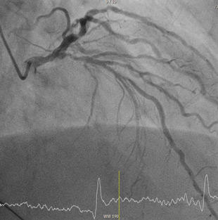 Initial Angiography