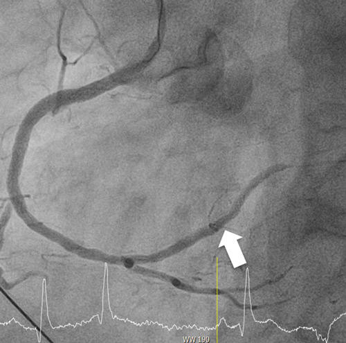 After Primary PCI of RCA and distal RCX