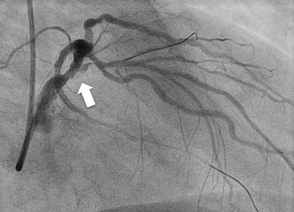After Primary PCI of RCA and distal RCX