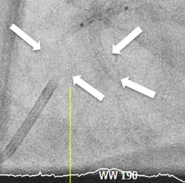 Detection of the distal part of the sculping balloon catheter in the distal guide catheter