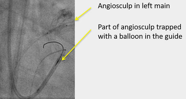 Angiosculp in left main, part of angiosculp trapped with a balloon in the guide
