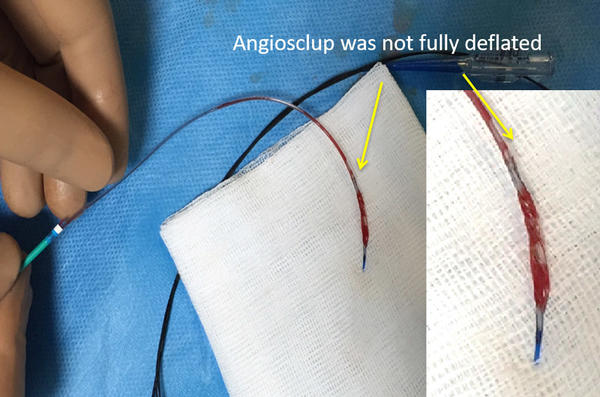 Angiosculp not fully deflated