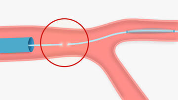 Complications balloon shaft fracture: illustration