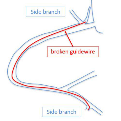 Broken guidewires and side branchs