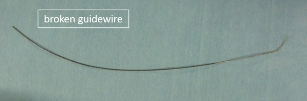 Broken guidewire
