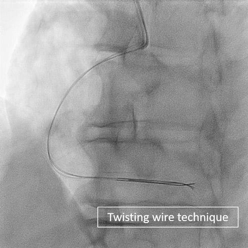 Twisting wire technique