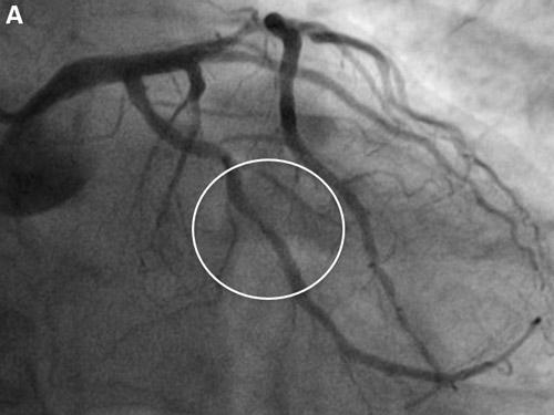 Severe mid left circumflex stenosis