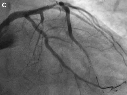 Result after stent deployment