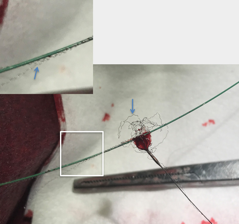Fractured guidewire protruding 