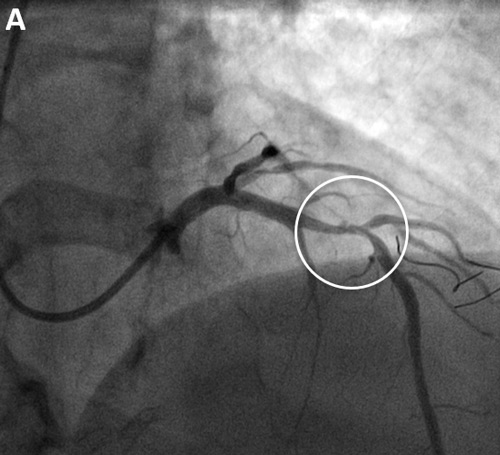 Severe mid left anterior descending stenosis