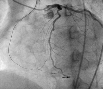 Second attempt CTO of RCA