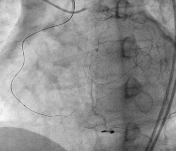 Second attempt CTO of RCA