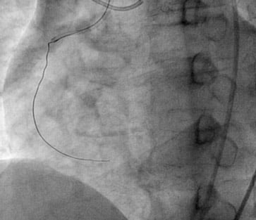 Second attempt CTO of RCA