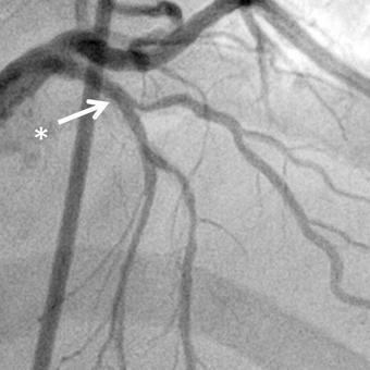 Carbostent Sirius™ 3.0x9 mm previously on proximal LAD