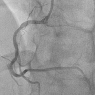 Mild disease of RCA