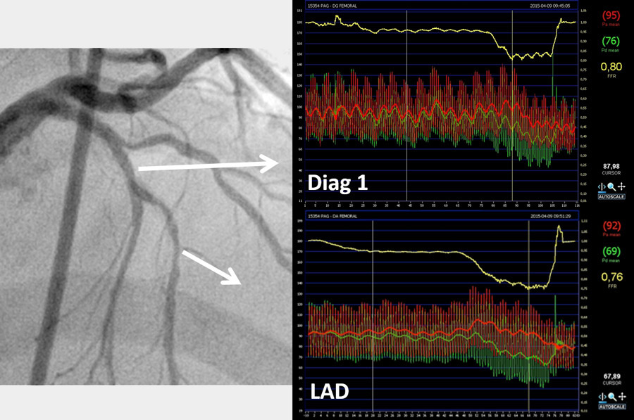Bifurcation PCI 
