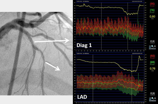 Bifurcation PCI 