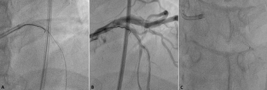 Traction caused the disruption in the guidewire main body spiral